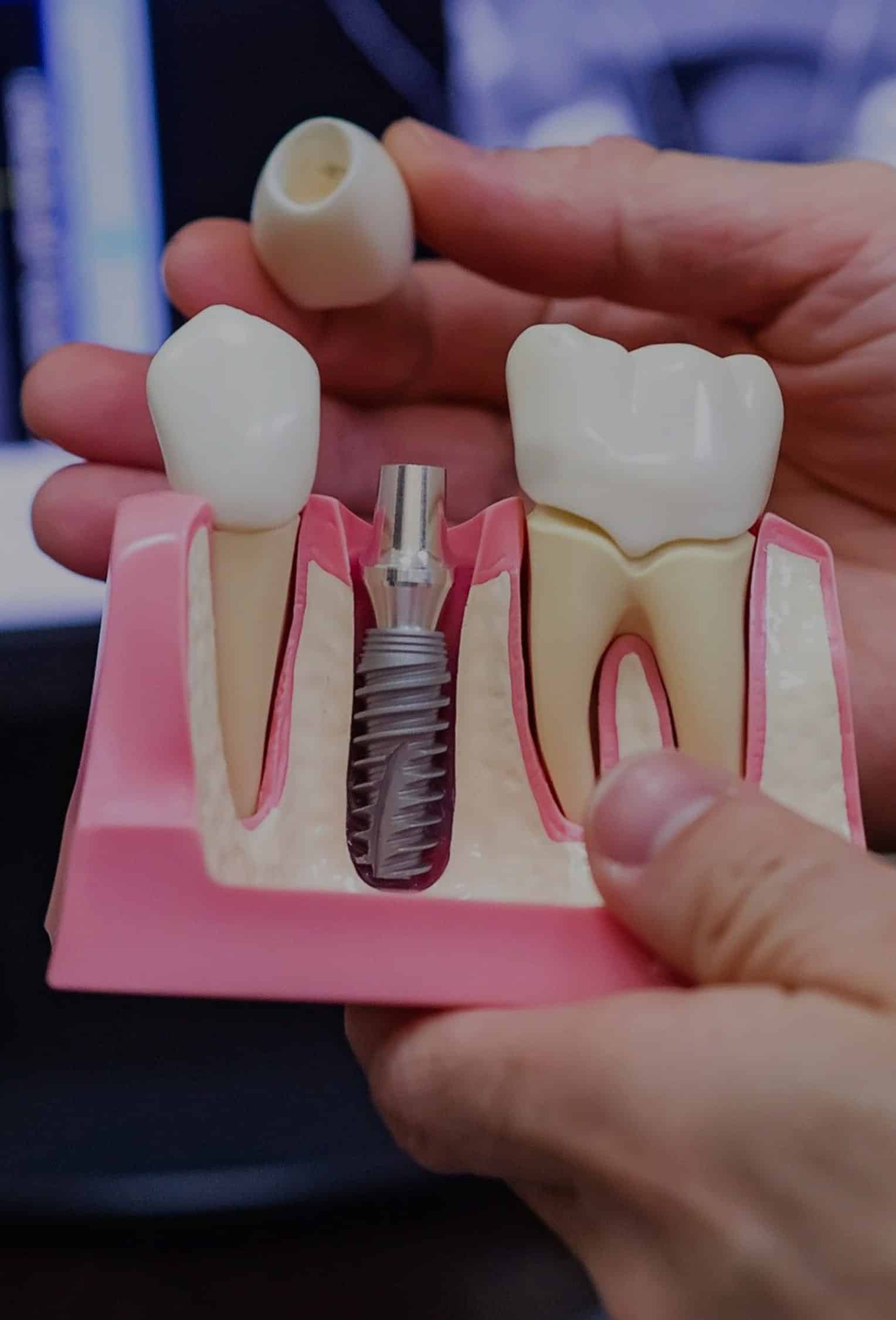 Dental implant Westerville - Westar Dental Westerville